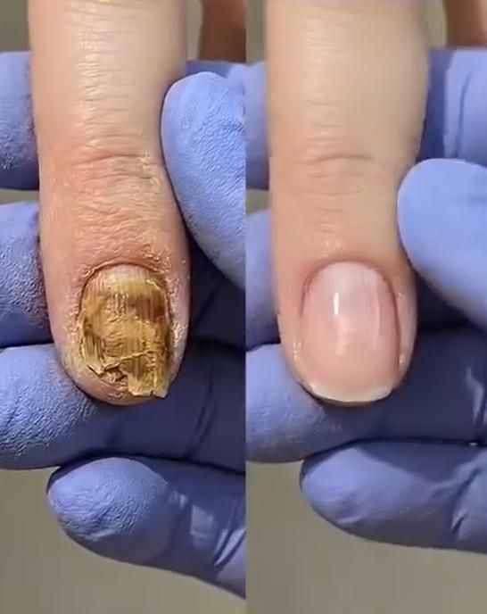 3 Days Nail Care Keratin Amino Acids 16ml Each (Pack of 2) - Ashish shop's